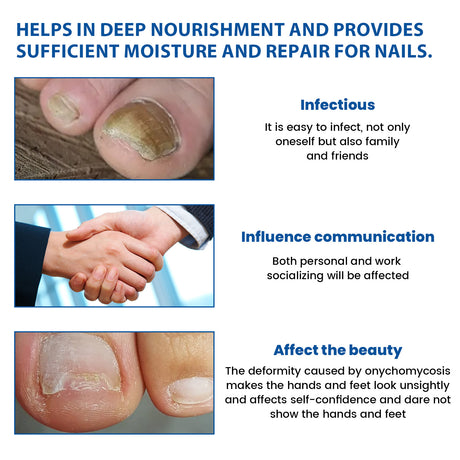 Nighttime Renewal Fungal Nail Patches, Repair And Thickening Gray Nail Insert Soft Nail Care Patch - V.I.P Digital Presence