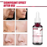 AHA30% + BHA 2% Fruit Acid Salicylic Acid Essence, Exfoliating Cleaning Blackheads Acne And Shrinking Pores Essence - V.I.P Digital Presence