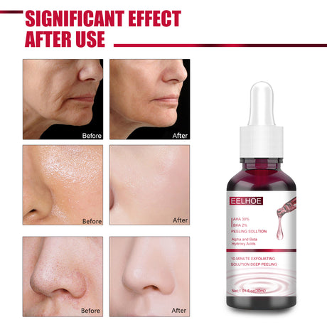 AHA30% + BHA 2% Fruit Acid Salicylic Acid Essence, Exfoliating Cleaning Blackheads Acne And Shrinking Pores Essence - V.I.P Digital Presence
