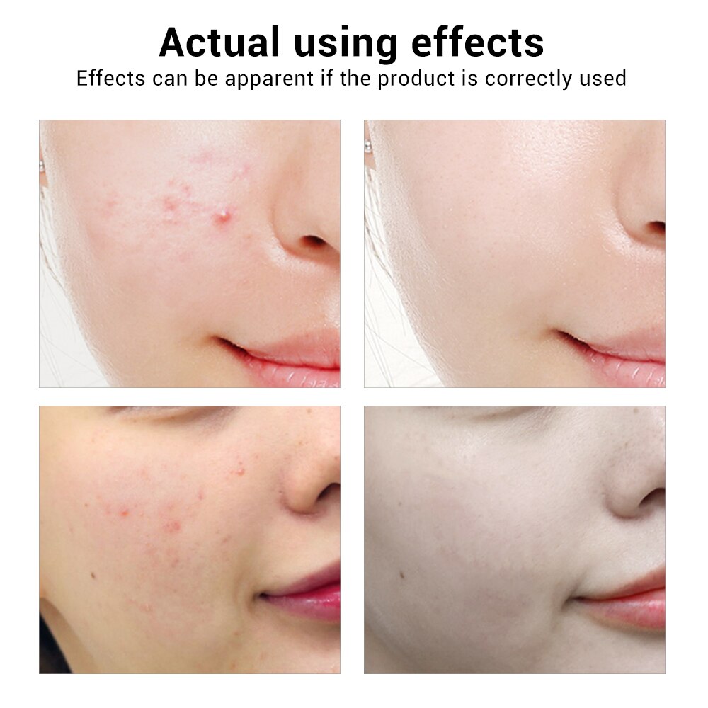 BREYLEE Acne Treatment Face Serum Mask Anti Acne Pimple Scar Remover Moisturizing Whitening Skin Care Facial Essence Cream 17ml - V.I.P Digital Presence