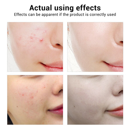BREYLEE Acne Treatment Face Serum Mask Anti Acne Pimple Scar Remover Moisturizing Whitening Skin Care Facial Essence Cream 17ml - V.I.P Digital Presence