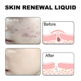 Skin Renewal Liquid, Reduce Acne Print Repair Acne Muscle Mild Clear Acne Hydrating Essence - V.I.P Digital Presence