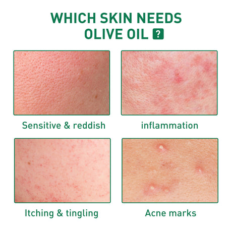 Tea Tree Oil Acne Serum, Remove Acne, Clear Acne, Repair Skin, Lighten Acne Printing Face Essence - V.I.P Digital Presence