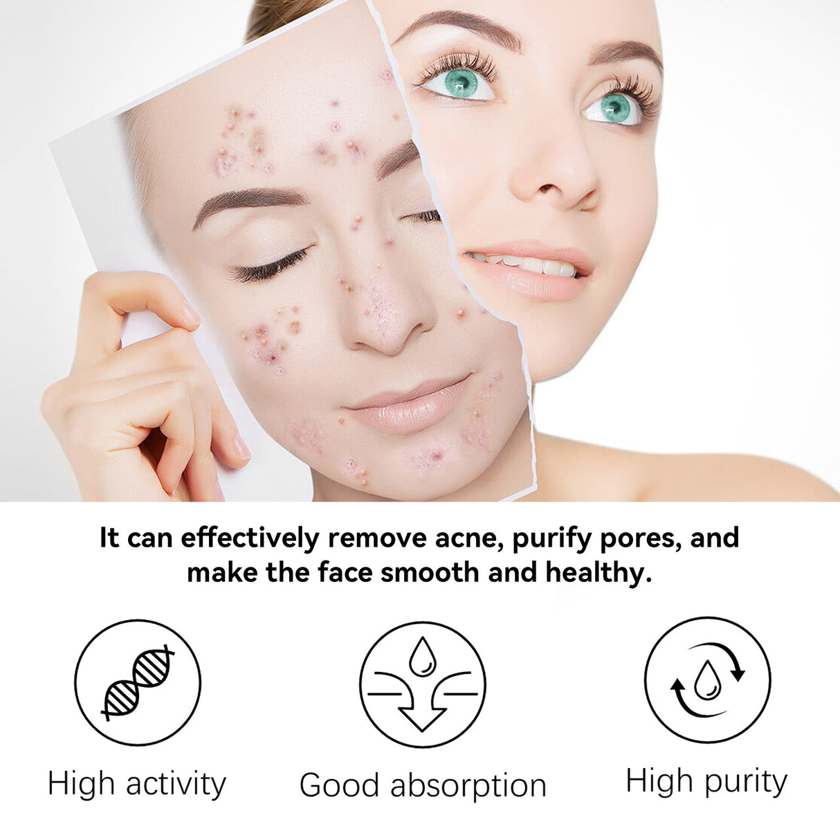 Herbal Acne Serum, Reduce Acne Pimples With A Comprehensive Moisturizing Moisturizer - V.I.P Digital Presence