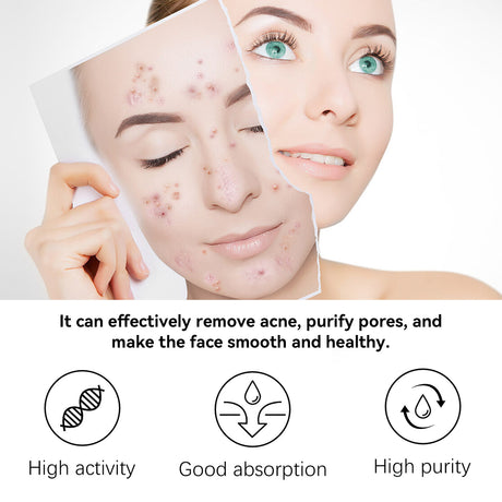 Herbal Acne Serum, Reduce Acne Pimples With A Comprehensive Moisturizing Moisturizer - V.I.P Digital Presence