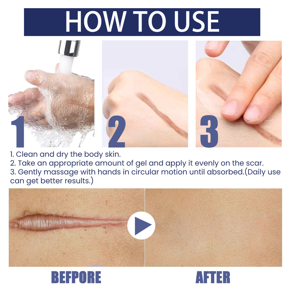 Scar Gel, Fade Skin Scar Pregnancy Surgery Scar Moisturizing Skin Care Gel - V.I.P Digital Presence