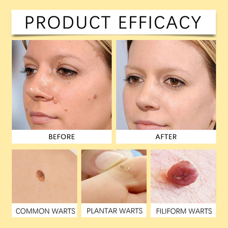Bee Venom Wart & Mole Removal Spray, Gentle Cleansing Skin Moisturizing Moisturizing Smooth Skin Care - V.I.P Digital Presence