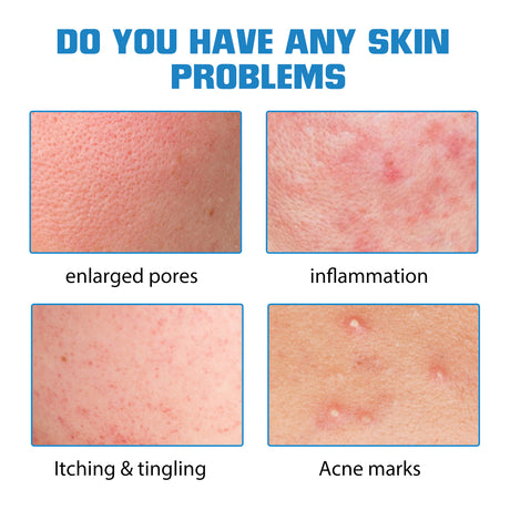 Hyaluronic Acid Face Serum, Moisturizing Repair Lighten Acne Mark Skin Care Whitening Essence - V.I.P Digital Presence