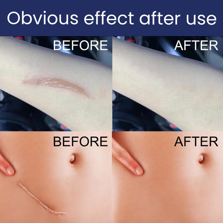 Scar Gel, Fade Skin Scar Pregnancy Surgery Scar Moisturizing Skin Care Gel - V.I.P Digital Presence