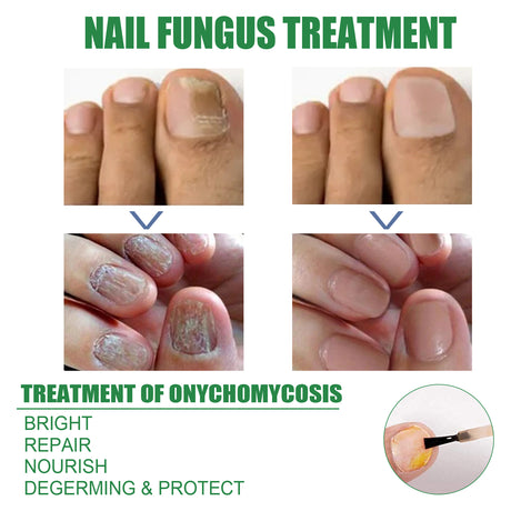 Nail Repair Solution Tea Tree Oil Essence Gentle Nourishing Manicure Cleansing Soft Nail Care Solution - V.I.P Digital Presence