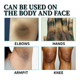 Acanthosis Nigricans Therapy Lotion, Skin Moisturizing Clean Black Dark Heavy Alar Knee Joint Repair Carry Bright Color Of Skin - V.I.P Digital Presence