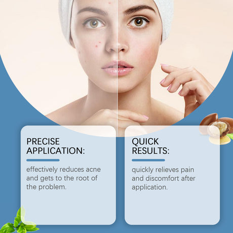 Acne Care Pen, Gently Clean Acne And Acne Closing Skin Daily Care Solution - V.I.P Digital Presence