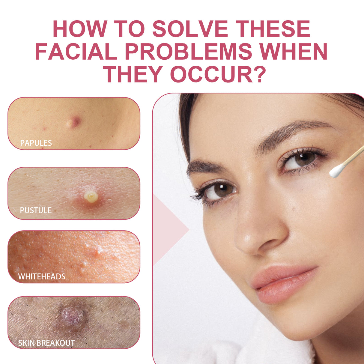 Salicylic Acid Acne Drying Lotion, Gentle Repair Acne-Skin Skin Moisturizing Lotion - V.I.P Digital Presence