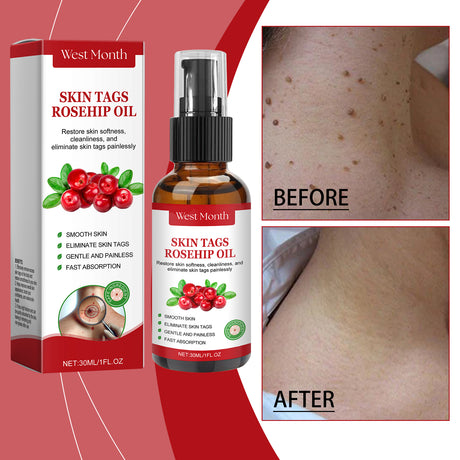 Rosehip Seed And Wart Essence Oil, Moisturizes And Restores Smooth Skin - V.I.P Digital Presence
