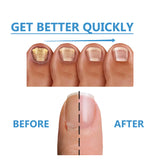 Nighttime Fungal Nail Treatment Patch, Repair Hand And Foot Inlay Rotten Nails Thickening Gray Nail Polish Care Patch - V.I.P Digital Presence