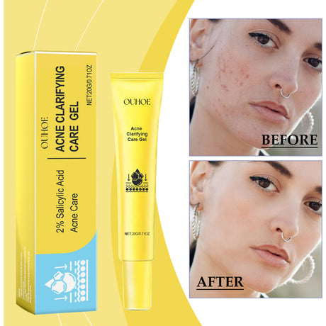 Acne-Clearing Gel, Deep Cleansing Facial Skin Brightening And Concealer Treatment Gel For Acne Reduction - V.I.P Digital Presence