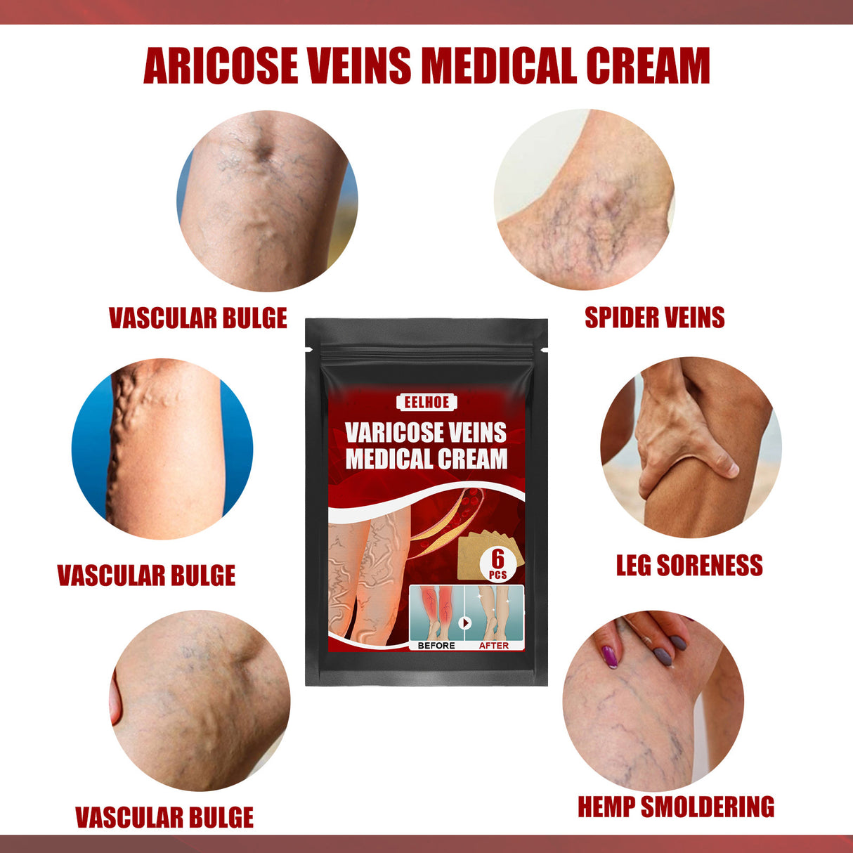 Aricose Veins Medical Cream, Relieve Leg Swelling Earthworm Leg Vein Massage To Relieve Pain - V.I.P Digital Presence
