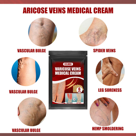 Aricose Veins Medical Cream, Relieve Leg Swelling Earthworm Leg Vein Massage To Relieve Pain - V.I.P Digital Presence