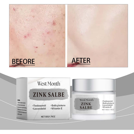 Acne Cream, Refreshing Oil Control Repair Acne Mild Soothing Closing Face Cream - V.I.P Digital Presence