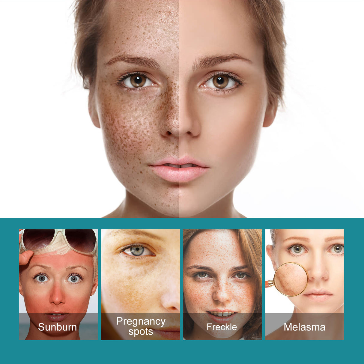 Whitening Spot Cream Hydrates And Moisturizes Skin To Lighten Spots, Acne Whitening, Brightening And Rejuvenating Skin Beauty Cream