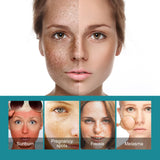 Whitening Spot Cream Hydrates And Moisturizes Skin To Lighten Spots, Acne Whitening, Brightening And Rejuvenating Skin Beauty Cream