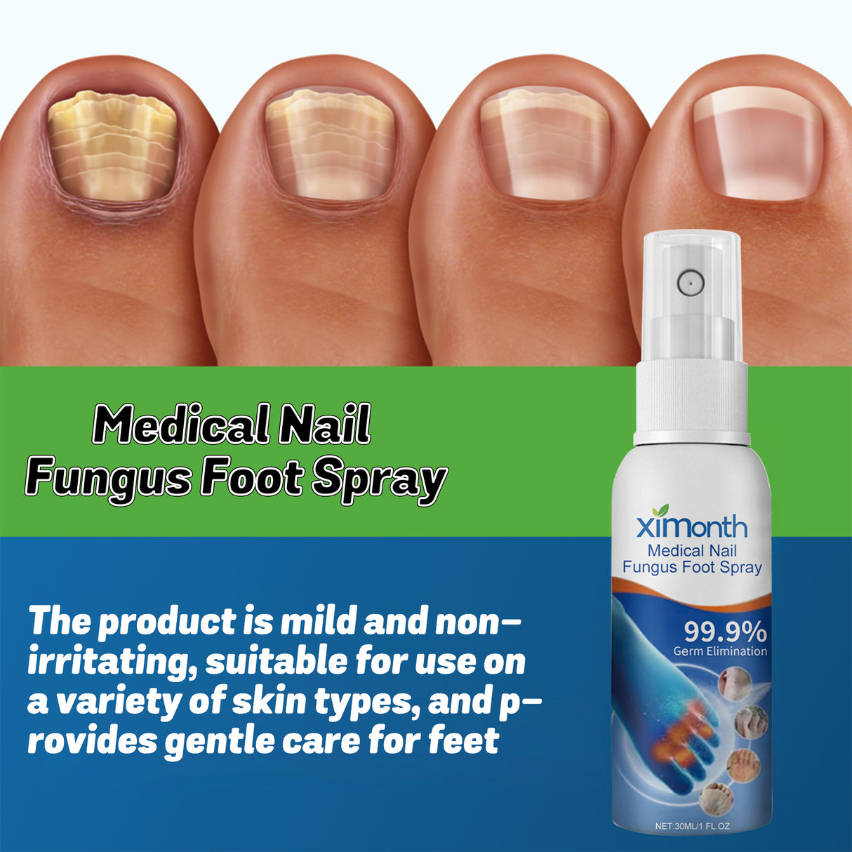 Medical Nail Fungus Foot Spray, Repair Thickening Gray Nail Rot Foot Moisturizing And Cleansing Armor - V.I.P Digital Presence