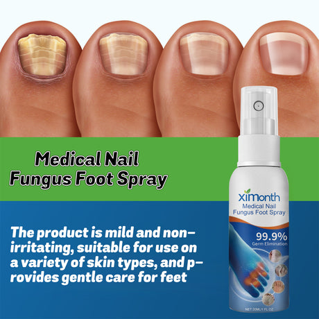 Medical Nail Fungus Foot Spray, Repair Thickening Gray Nail Rot Foot Moisturizing And Cleansing Armor - V.I.P Digital Presence