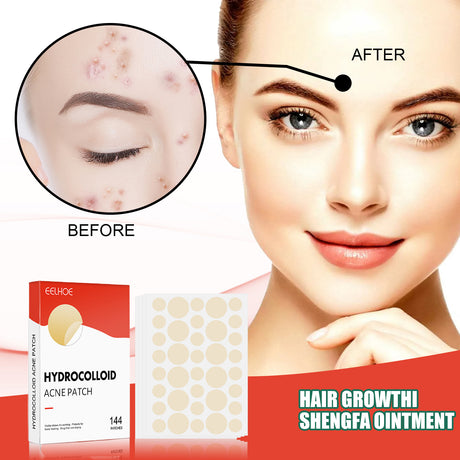 Hydrocolloid Acne Patch Face Invisible Makeup Closed Mouth Acne Clear Acne Waterproof Breathable Facial Treatment - V.I.P Digital Presence
