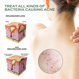 Body Acne Removal Cleanser Spray, Deep Clean Back Arm Fade Acne Beauty Moisturizing Spray - V.I.P Digital Presence