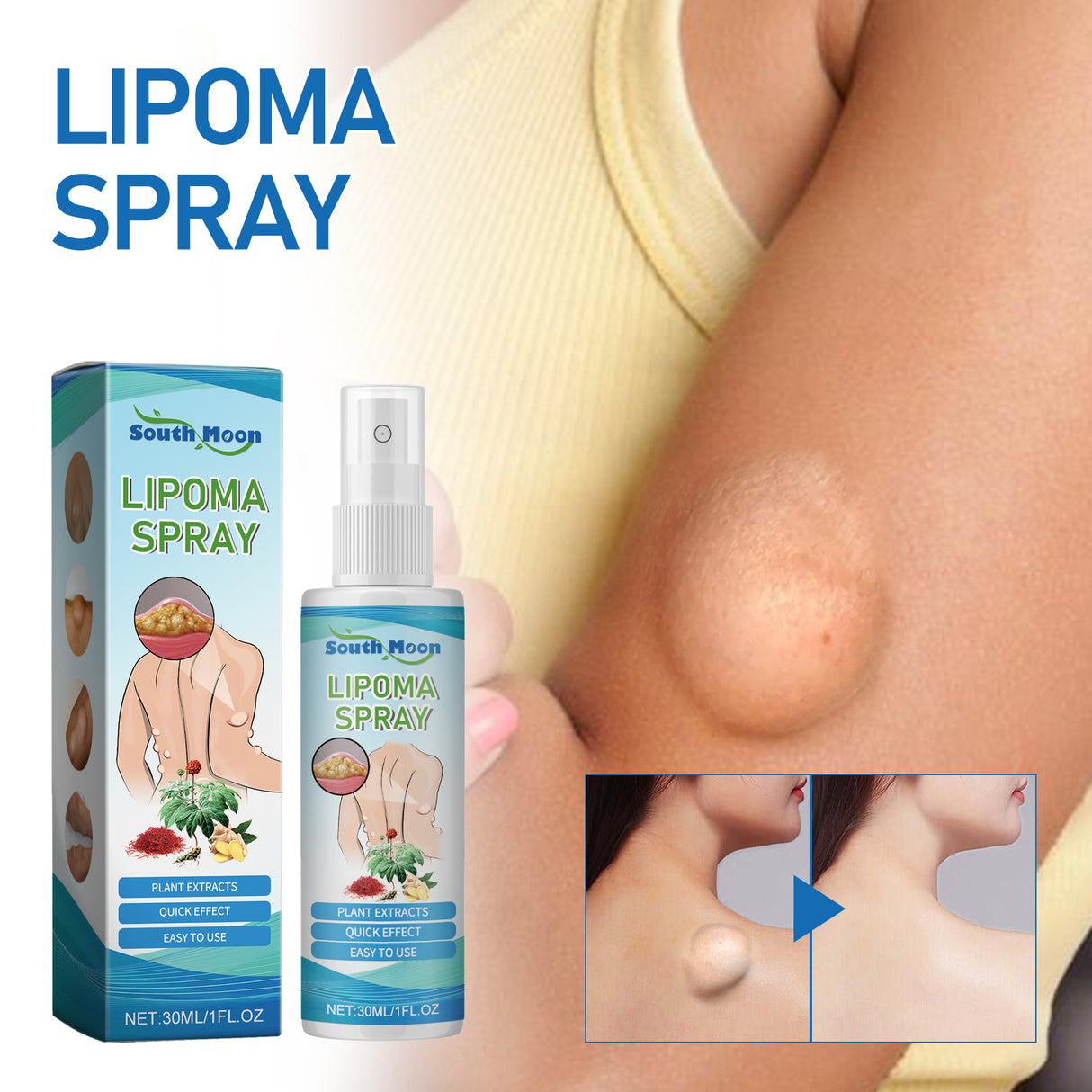 Lipoma Spray, Body Subcutaneous Fat Dredging Treatment To Relieve Lumps And Clumps - V.I.P Digital Presence