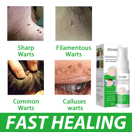 Skin Wart Removal Liquid, Skin Tag Cleaning Remove Hand And Foot Cocoon Corns Wart Removal Liquid - V.I.P Digital Presence