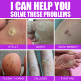 Remove Chicken Eye Lotion Extra Clear Remove Corns Skin Care Chicken Calluses Foot Pad Gram Warts - V.I.P Digital Presence