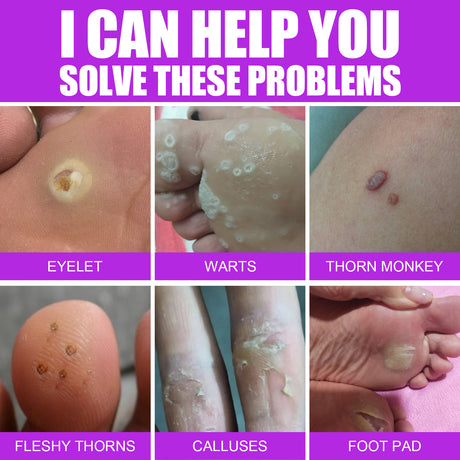 Remove Chicken Eye Lotion Extra Clear Remove Corns Skin Care Chicken Calluses Foot Pad Gram Warts - V.I.P Digital Presence