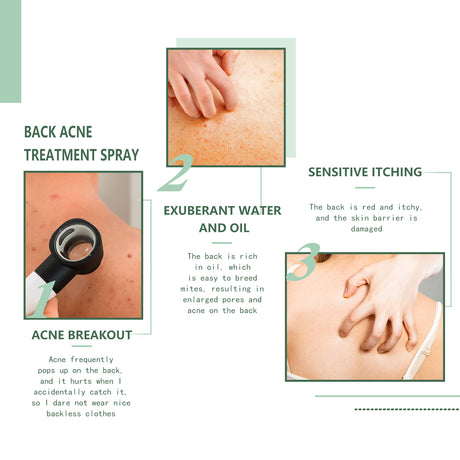 Body Acne Removal Cleanser Spray, Deep Clean Back Arm Fade Acne Beauty Moisturizing Spray - V.I.P Digital Presence