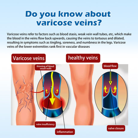 Varicose Vein Slimming Cream, Vein Repair Body Care Reduces Leg Muscle Swelling Earthworm Leg Slimming Cream - V.I.P Digital Presence
