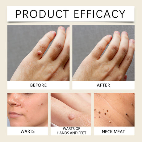 Mole And Wart Care Cream, Soft And Smooth Skin Moisturizing And Repairing Skin Care Cream - V.I.P Digital Presence
