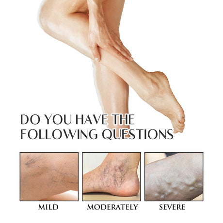 Varicose Veins Soothing Spray, Relief Of Sore Leg Muscles Massage Repair Earthworm Leg Vein Treatment Spray - V.I.P Digital Presence
