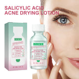 Salicylic Acid Acne Drying Lotion, Gentle Repair Acne-Skin Skin Moisturizing Lotion - V.I.P Digital Presence