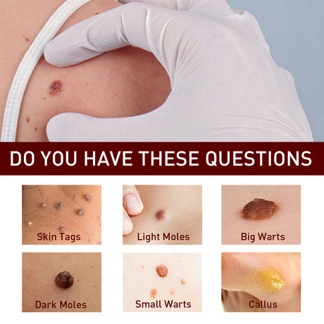Wart Cream Pen, Skin Tags Gram Warts Fade Moles Corns Smooth Moisturizing Skin Repair - V.I.P Digital Presence