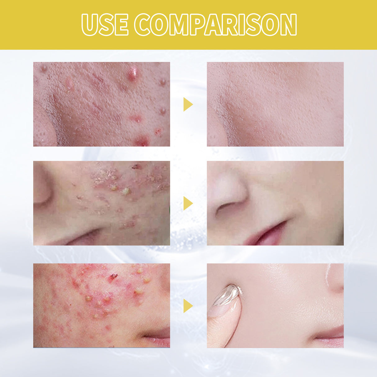 Orchid Acne Essential Oil Cleans And Brightens Pores And Hydrates Facial Care Essence