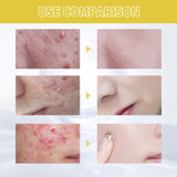 Orchid Acne Essential Oil Cleans And Brightens Pores And Hydrates Facial Care Essence