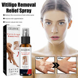 Vitiligo Removal Relief Spray, Repair Whitening Spot Perspiration Beauty Moisturizing Skin Care spray - V.I.P Digital Presence
