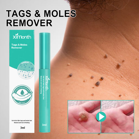 Keyu Liquid Repair Smooth Face Body Skin Deep Cleaning Moles Corns Keyu Liquid Pen - V.I.P Digital Presence