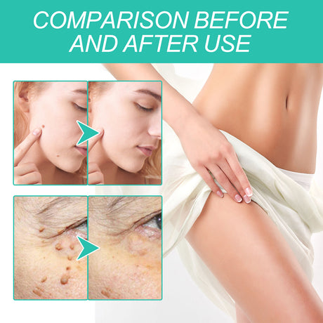 Keyu Liquid Repair Smooth Face Body Skin Deep Cleaning Moles Corns Keyu Liquid Pen - V.I.P Digital Presence