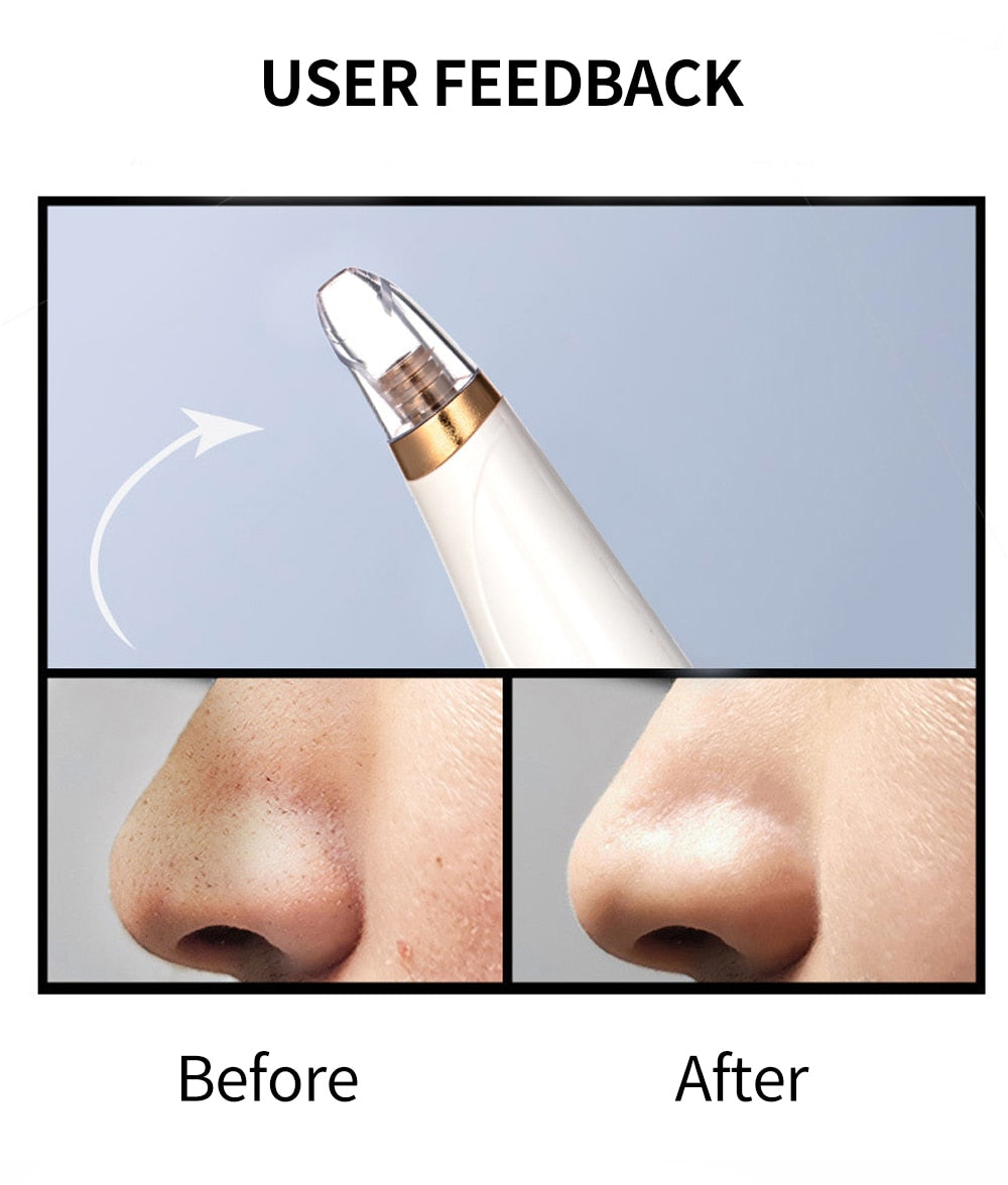 Blackhead Remover Face Deep Pore Cleaner Removal Vacuum Suction Facial SPA Diamond Beauty Care Tool Skin Care - V.I.P Digital Presence