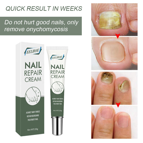 Foot Care And Thickening Nail Repair Cream. Nail Repair Cream - V.I.P Digital Presence
