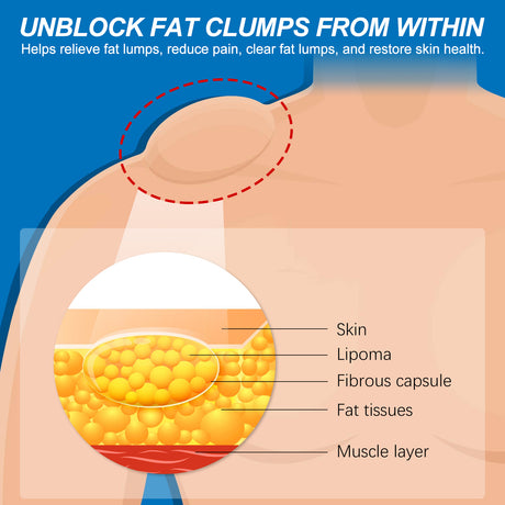 Lipoma Spray, Body Subcutaneous Fat Dredging Treatment To Relieve Lumps And Clumps - V.I.P Digital Presence