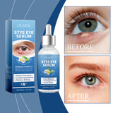 Eye Care Solution, A Gentle Moisturizing Eye Solution That Relieves Acidness, Is A Daily Portable Eye Care Drops - V.I.P Digital Presence