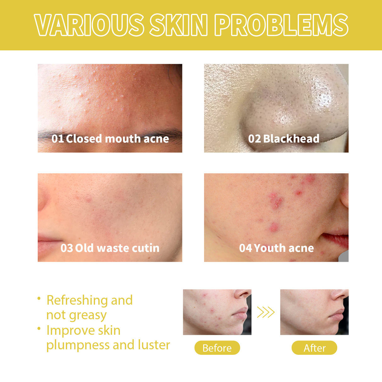 Orchid Acne Essential Oil Cleans And Brightens Pores And Hydrates Facial Care Essence