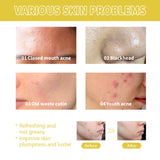 Orchid Acne Essential Oil Cleans And Brightens Pores And Hydrates Facial Care Essence